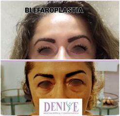 Antes y después de Blefaroplastia - Clínica Denisse