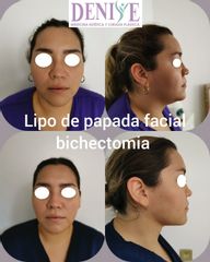 Antes y después de Lipopapada + Bichectomia - Clínica Denisse