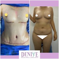 Antes y después de Lipoescultura - Clínica Denisse