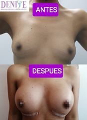 Antes y después de Aumento de busto - Clínica Denisse