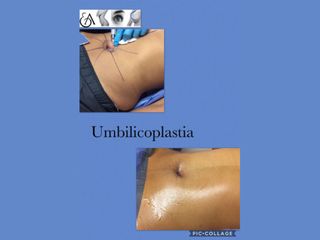 Antes y después de Abdominoplastia