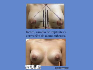 Antes y después de Mastopexia