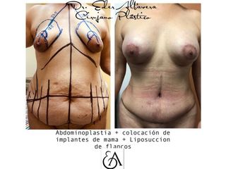 Antes y después de Abdominoplastia
