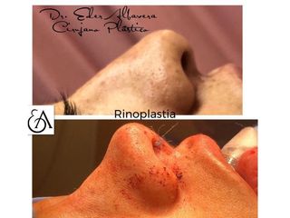 Antes y después de Rinoplastia