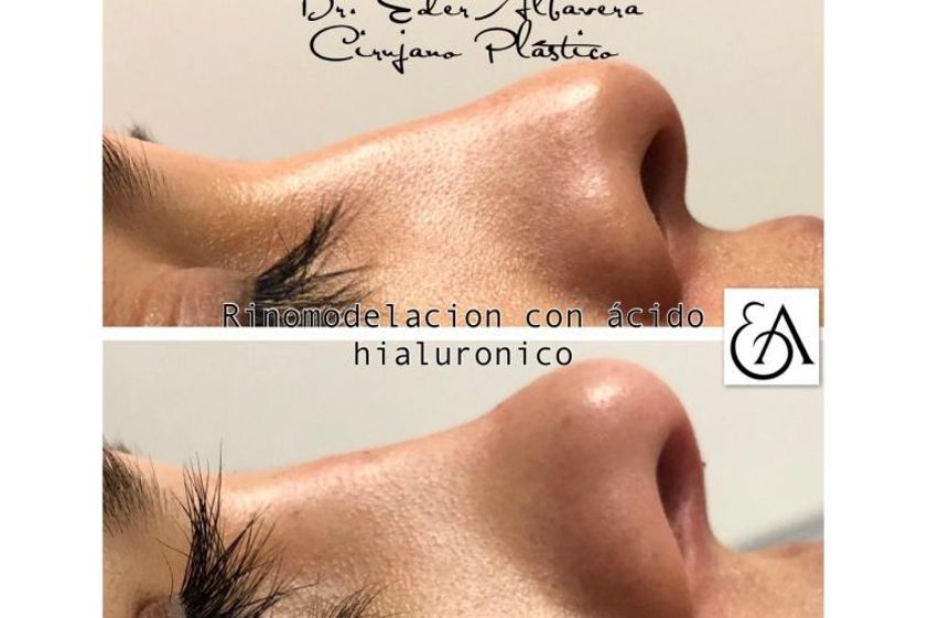 Rinomodelación antes y después - 648402
