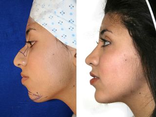 Antes y después de Mentoplastia y rinoplastia