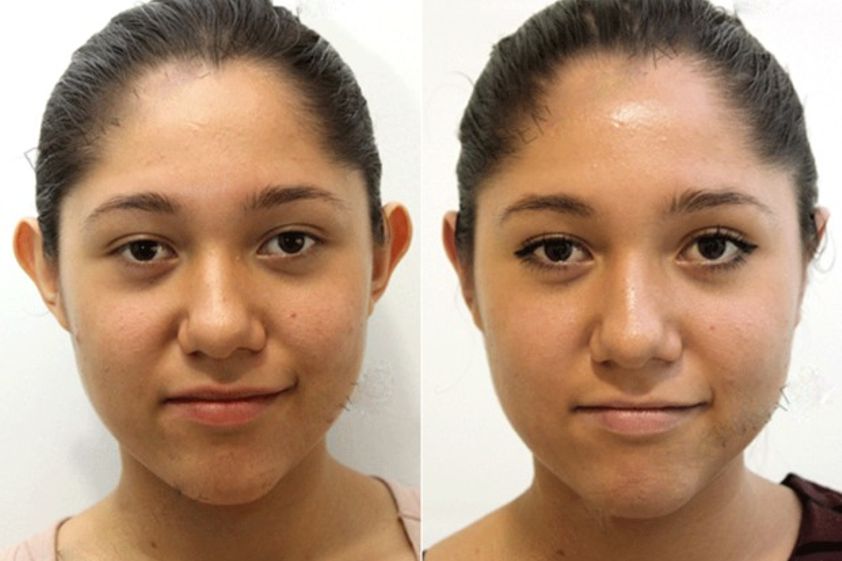 Otoplastia antes y después - 497364