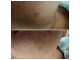 Antes y después de  Microdermoabrasión par desvancer manchas 