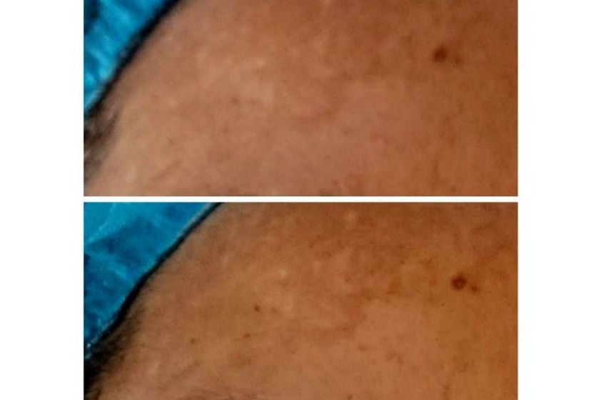 Microdermoabrasión antes y después - 642042