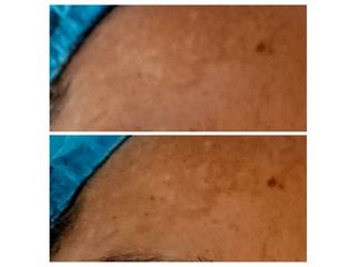 Antes y después de tratamiento de manchas en la piel 