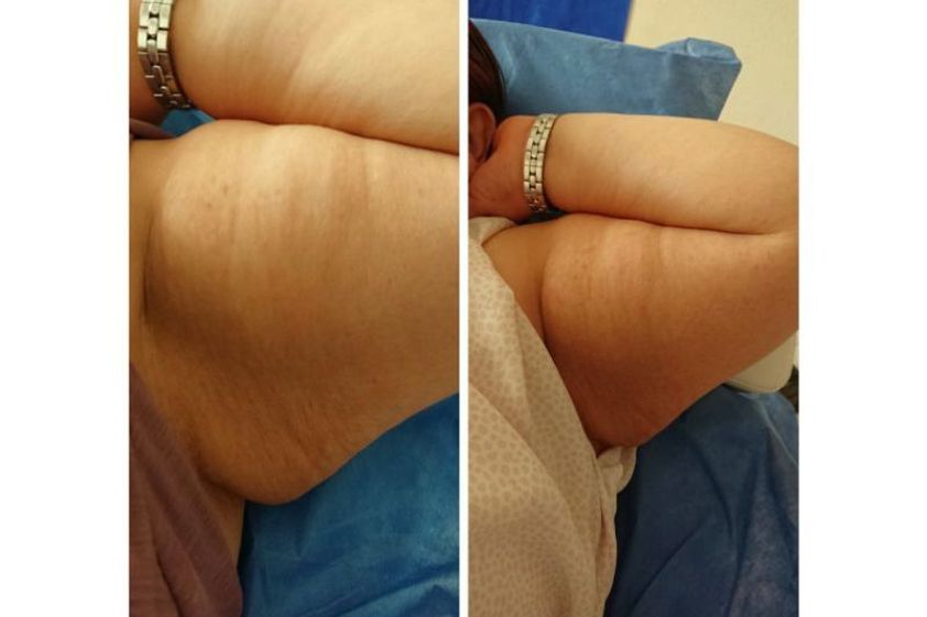 Mesoterapia antes y después - 642044