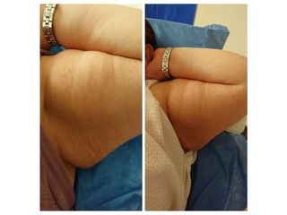Antes y después de dismunución de grasa corporal en el ala de murciélago