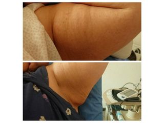 Antes y después de dismunución de grasa corporal en el ala de murciélago