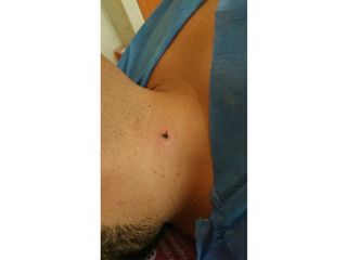 RETIRO DE LUNAR VERRUGOSO EN CUELLO