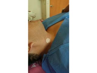 RETIRO DE LUNAR VERRUGOSO EN CUELLO