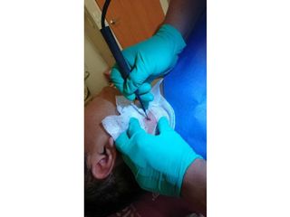 RETIRO DE LUNAR VERRUGOSO EN CUELLO