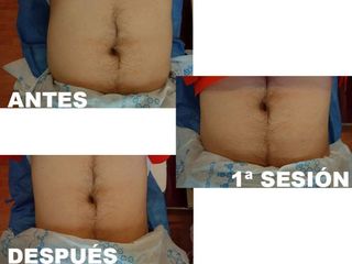 CAVITACIÓN, RADIOFRECUENCIA Y VACUMTERAPIA
