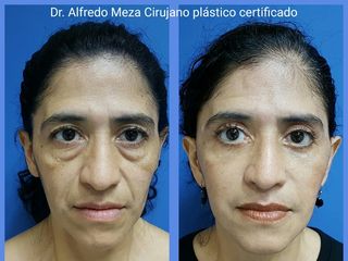 Antes y después de Rejuvenecimiento facial completo