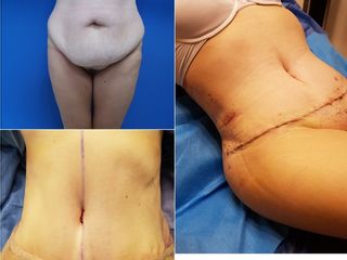 Antes y después de Abdominoplastia