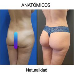 Gluteoplastia - Cirugía Plástica Estética. Dr. Alfredo Meza.
