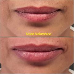 Aumento de labios - Cirugía Plástica Estética. Dr. Alfredo Meza.