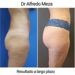 Gluteoplastia - Cirugía Plástica Estética. Dr. Alfredo Meza.