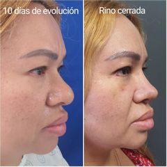 Rinoplastia - Cirugía Plástica Estética. Dr. Alfredo Meza.