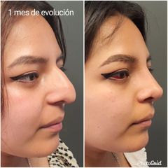 Rinoplastia - Cirugía Plástica Estética. Dr. Alfredo Meza.