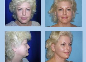 Intraoral Face Lift