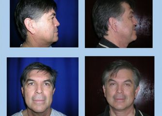 Male Face lift 