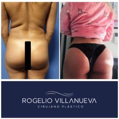 Antes y después de gluteoplastia