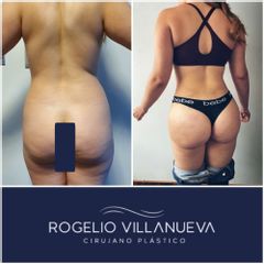 Antes y después de gluteoplastia