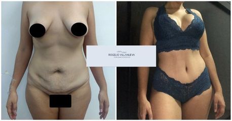 Antes y después de Mommy makeover