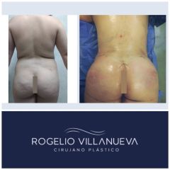 Antes y después de lipoescultura