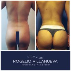 Antes y después de lipoescultura