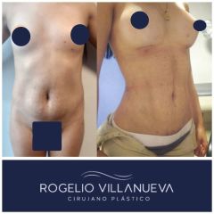 Antes y después de lipoescultura