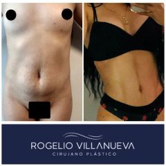 Antes y después de un aumento de busto 