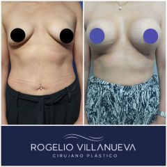 Antes y después de un aumento de busto 