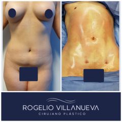 Antes y después de liposucción
