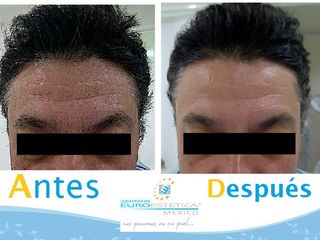 Antes y después de Rejuvenecimiento Facial