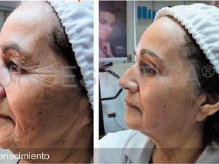 Antes y después de rejuvenecimiento facial