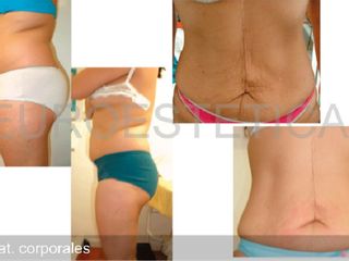 Antes y despues de tratamientos corporales