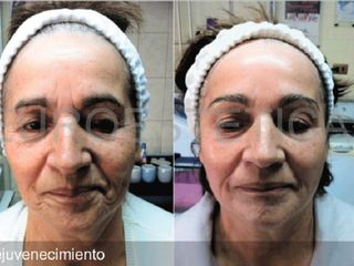 Antes y después de rejuvenecimiento facial