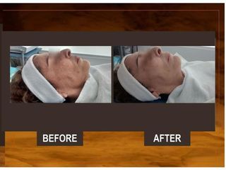 Antes y después de Tratamiento Facial con Suero orgánico
