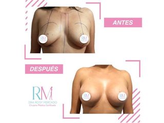 Antes y después de aumento de busto - Dra. Rosy Mercado 