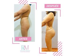 Antes y después de liposucción - Dra. Rosy Mercado 
