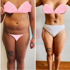 Antes y después de abdominoplastía extendida - Dra. Rosy Mercado
