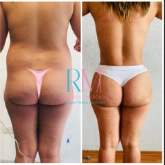Antes y después de Abdominoplastía extendida - Dra. Rosy Mercado