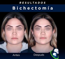 Bichectomia - Dr. Ricardo Guillén