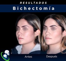 Bichectomia - Dr. Ricardo Guillén